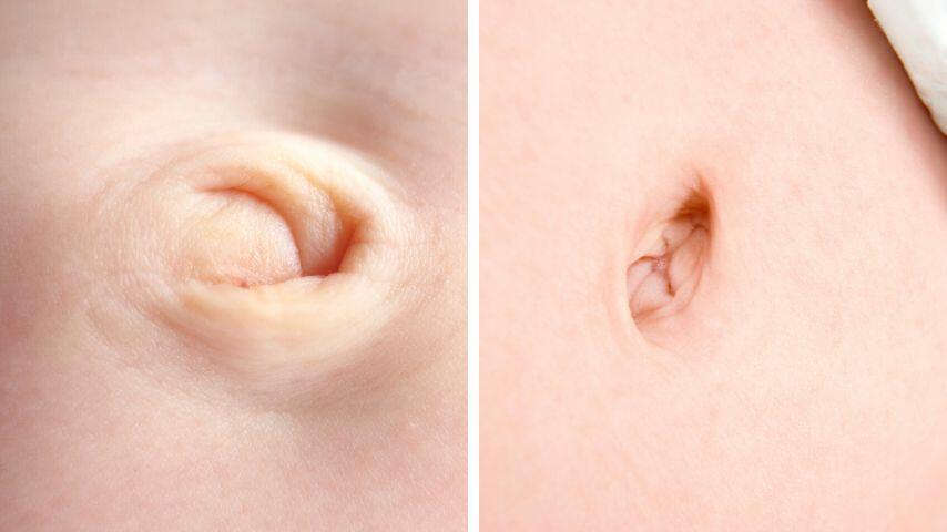 Inverted nipples are like navels that go in (innie) instead of going out (outie) Inverted nipples are like navels that go in (innie) instead of going out (outie)